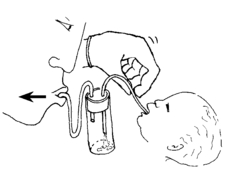 Como esterilizar uma seringa de bulbo