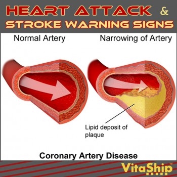 Ранни признаци и симптоми на сърдечна болест при жените